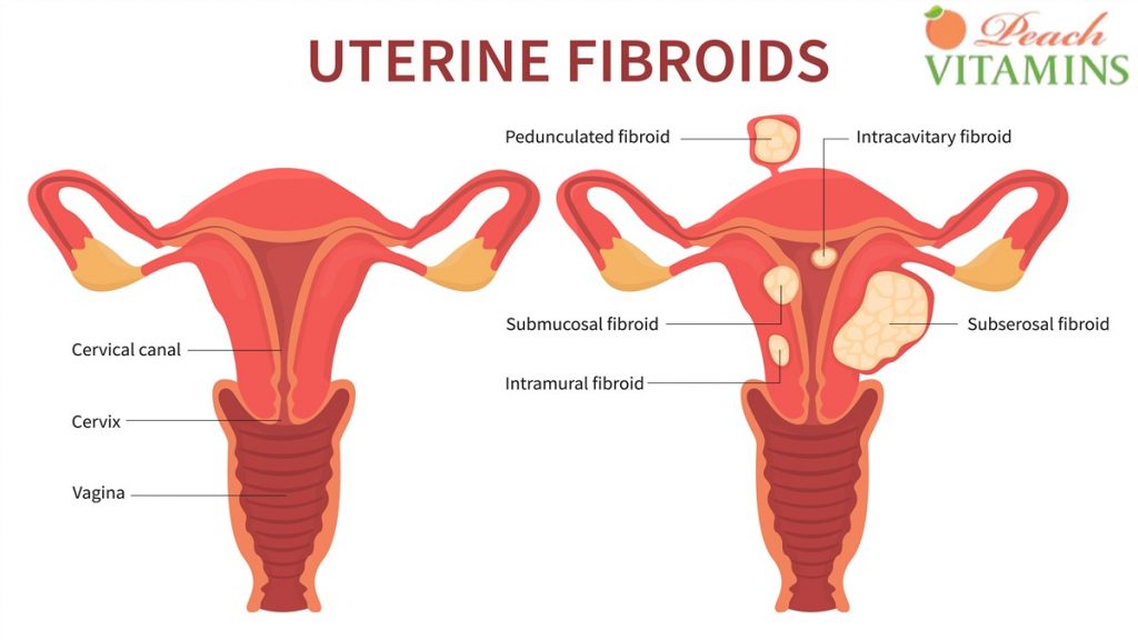 Top 9 Natural Remedies for Managing Fibroids