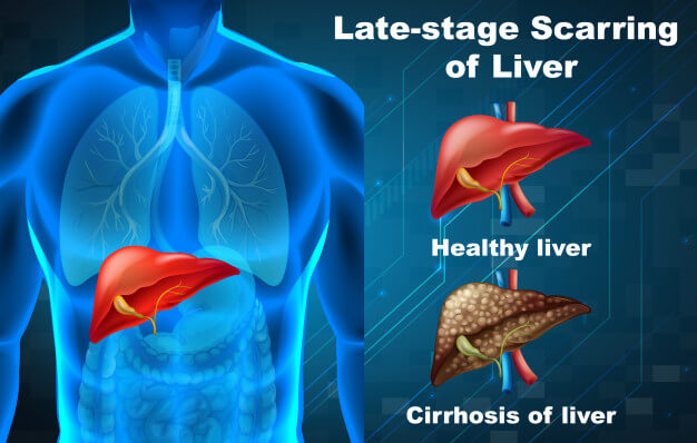 can silymarin cure fatty liver