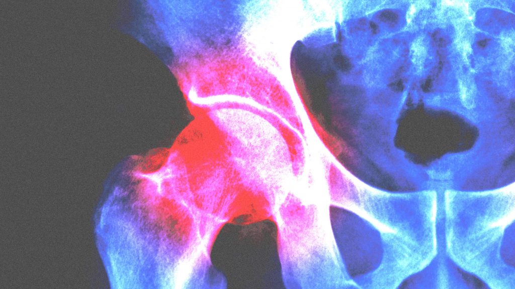 Ayurvedic Medicine for Hip Joint Pain – Treatment Options for Hip Pain