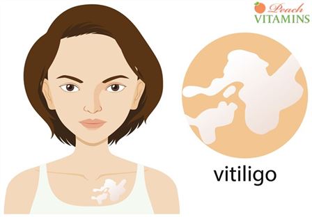 Ayurvedic Home Remedies For Vitiligo