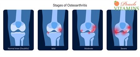 Osteoarthritis Knee Treatment In Ayurveda