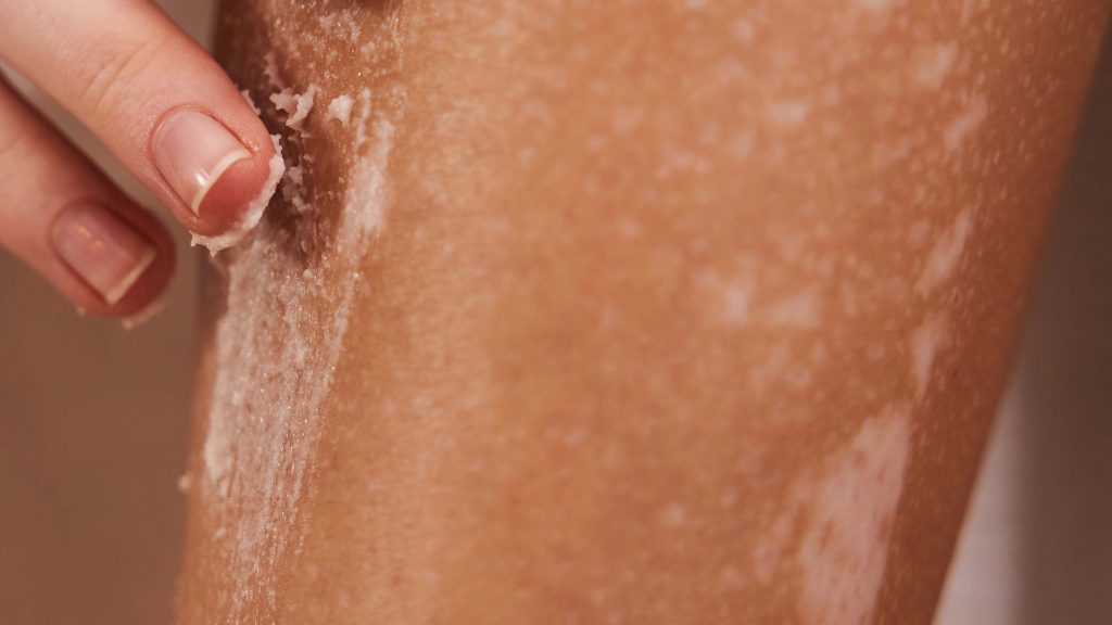 Vitiligo Cure In Ayurveda – Top Ayurvedic Treatment for Vitiligo